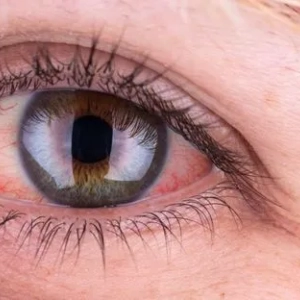 Cauza ochilor roșii la adulți și metodele de tratament. Leziuni și boli ale ochilor